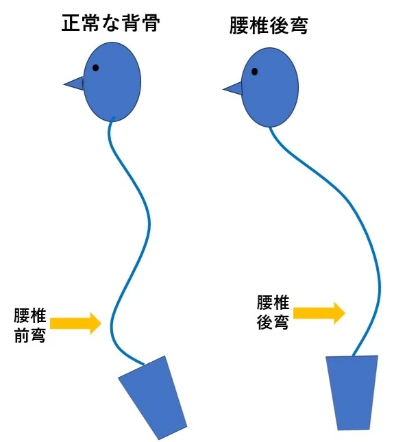 腰椎後側弯