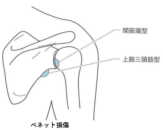ベネット損傷とは？