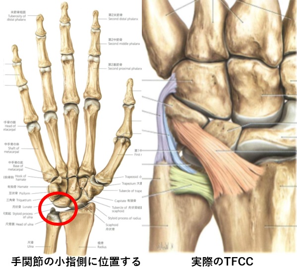 TFCC損傷とは?