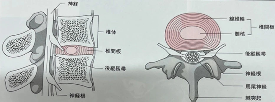 腰椎ヘルニア１