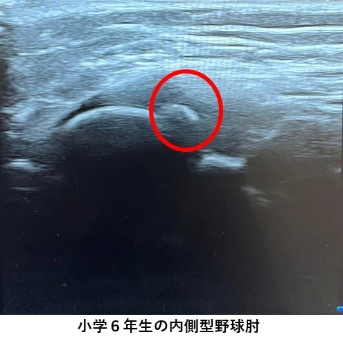 内側型野球肘